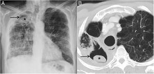 Chest radiograph (A) and CT (B) show a destructive pattern of the right lung and a stable, previously documented, aspergilloma (asterisk) within a dominant right upper lobe cavity (arrow).