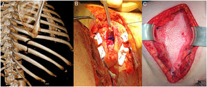 A) Reconstrucción en 3D de la tomografía computarizada que muestra fracturas del 7.°, 8.° y 9.° arcos costales, así como diástasis intercostal del séptimo espacio con herniación pulmonar a dicho nivel. B) Defecto diafragmático de 5cm suturado con puntos de Prolene® apoyados en politetrafluoroetileno. C) Malla biológica (Permacol® sobre plano costal.