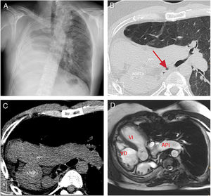 A) Radiografía de tórax, proyección posteroanterior, en la que se objetiva desplazamiento mediastínico y del pulmón izquierdo hacia el hemitórax derecho causado por ausencia del pulmón derecho (agenesia pulmonar). B) Corte axial tomográfico con ventana de parénquima pulmonar. La flecha indica el bronquio principal derecho rudimentario que acaba en fondo de saco. C) Corte axial tomográfico sin contraste intravenoso en el que se aprecia el desplazamiento de estructuras vasculares hacia el hemitórax derecho, así como ausencia de arteria pulmonar derecha. API: arteria pulmonar izquierda. D) Corte axial oblicuo de cine-RM b-FFE. Se observa dextrocardia, dextro-ápex y la ausencia completa de parénquima pulmonar derecho. VD: ventrículo; VI: ventrículo izquierdo.