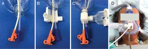Therapeutic use of tube adaptor for NIMV with two tubes. (A) The tube for enteral feeding and gastric drainage probe are passed through the central hole of the mask. (B) The tube adaptor for non-invasive mechanical ventilation is opened. (C) The tube adaptor for non-invasive mechanical ventilation closed around the tubes, inserted into the mask and attached to ventilator circuit. (D) The use of a tube adaptor for tube for enteral feeding and gastric drainage probe during non-invasive mechanical ventilation therapy in a patient.