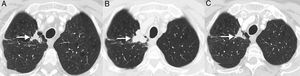 Ejemplo de seudoprogresión en paciente de 59 años con cáncer de pulmón no microcítico en progresión que inicia tratamiento de segunda línea con inmunoterapia (nivolumab). A) Imagen axial basal (preinmunoterapia) de TC de tórax (ventana de parénquima pulmonar) en la que se identifica una lesión tumoral primaria en vértice pulmonar derecho (flecha). B) Imagen axial de TC de tórax a las 8 semanas del inicio de tratamiento con nivolumab en la que se aprecia una progresión radiológica de la lesión tumoral pulmonar (flecha); esta aparente progresión tumoral no se acompaña de empeoramiento clínico, por lo que se decide continuar con el tratamiento. C) Imagen axial de TC de tórax obtenida 6 semanas después en la que se demuestra una reducción significativa del tamaño de la lesión (flecha), confirmándose una seudoprogresión. Según criterios convencionales de respuesta (RECIST), el tratamiento se habría interrumpido en cuanto se demuestra progresión radiológica.