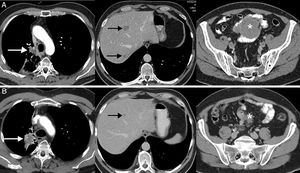 Ejemplo de respuesta disociada/paradójica en paciente de 57 años con cáncer de pulmón no microcítico en progresión que inicia tratamiento de segunda línea con inmunoterapia (pembrolizumab); la fila superior (A) corresponde a la TC basal (preinmunoterapia) mientras que la fila inferior (B) corresponde a la TC obtenida a las 8 semanas del inicio del tratamiento. A) Imágenes axiales basales (preinmunoterapia) de TC de tórax, abdomen y pelvis (de izquierda a derecha, respectivamente) en las que se observa el tumor pulmonar primario (flecha blanca), metástasis hepáticas (flechas negras) y una masa mesentérica (asterisco). B) Imágenes axiales de TC a las 8 semanas del inicio de tratamiento de tórax, abdomen y pelvis (de izquierda a derecha, respectivamente) en las que se aprecia una respuesta discordante de las lesiones tumorales: progresión pulmonar (flecha blanca) pero respuesta favorable de las metástasis hepáticas (flecha negra) y mesentérica (asterisco). Dado el buen estado general del paciente, se decidió resecar la lesión pulmonar, lográndose una respuesta completa del paciente en estudios radiológicos posteriores.