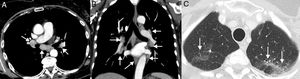Ejemplo de reacción sarcoidea. Paciente de 68 años diagnosticada de cáncer de pulmón metastásico en tratamiento con inmunoterapia (atezolizumab). La paciente presentaba una buena situación clínica y no había datos clínicos de progresión tumoral, aunque se quejaba de una tos seca de varias semanas de evolución. Durante el seguimiento con TC se observó la aparición de varias adenopatías en mediastino y en ambos hilios pulmonares (flechas) con una distribución relativamente simétrica (A y B, ventana de mediastino) y de varios nódulos pulmonares milimétricos (C, ventana de pulmón) con una distribución perilinfática en lóbulos superiores (flechas), sugiriéndose el diagnóstico radiológico de reacción sarcoidea. Una ecobroncoscopia confirmó la presencia de granulomas y descartó progresión tumoral. En este caso se decidió administrar corticoides pero no se suspendió la inmunoterapia, mejorando el cuadro clínico-radiológico.