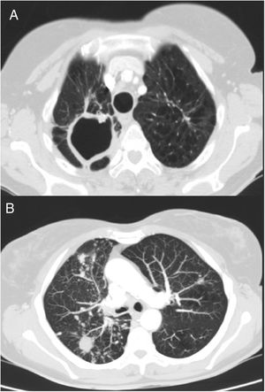 TC de tórax. A) Imagen de secuelas de proceso tuberculoso previo, con signos de pérdida de volumen de ambos lóbulos superiores y cicatrices parenquimatosas con gran cavidad en vértice derecho. B) Visión de múltiples nódulos bilaterales y difusos, algunos cavitados, y patrón micronodular de distribución en árbol en brote en lóbulo inferior derecho y lóbulo medio, en relación con el proceso infeccioso actual.