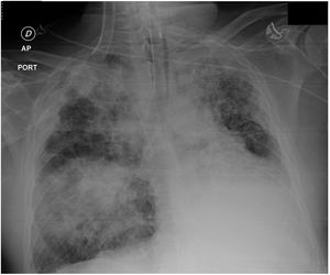 Condensación pulmonar basal derecha.