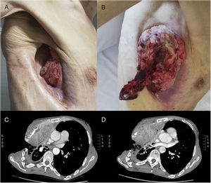 A) Tumoración que aflora por el orificio de la toracostomía abierta permanente. B) Gran crecimiento del tumor que ya ocupa todo el orificio días después. C y D) Cortes axiales de la TAC donde se aprecia la toracostomía y el tumor.