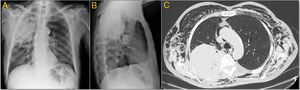 A y B) Radiografía simple de tórax en proyecciones PA y lateral. Voluminosa masa en lóbulo superior derecho, y discreto enfisema subcutáneo cervical. C) TC de tórax (corte axial, ventana de mediastino). Resorción de arcos costales posteriores en la localización de la masa, neumomediastino y enfisema subcutáneo masivo.