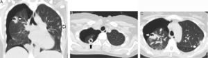 Tomografía computarizada torácica: A) Corte coronal; B y C) Corte transversal. Nódulos pulmonares cavitados periféricos (flechas) en el lóbulo superior derecho e izquierdo y neumotórax derecho.