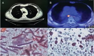 A) TAC de tórax donde se aprecia aumento en estación ganglionar 4R. B) PET/TAC con aumento de metabolismo en adenopatía subcarinal. C) Células gigantes con material birrefringente (×400) correspondiente al primer caso. D) Material amorfo birrefringente con luz polarizada correspondiente al segundo caso.
