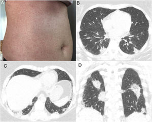 (A) Photograph showing a confluent maculopapular rash on the trunk. (B and C) Axial and (D) coronal computed tomography images demonstrating multiple peripheral consolidations, mainly in both lungs.