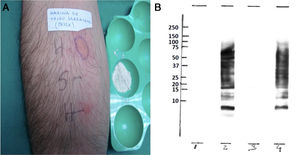 A) Prick by prick con harina de trigo sarraceno. B) IgE-inmunodetección de extractos de harina de trigo sarraceno. 1: trigo sarraceno (condiciones no reductoras)+control negativo. 2: trigo sarraceno (condiciones no reductoras)+suero paciente. 3: trigo sarraceno (condiciones reductoras)+control negativo. Trigo sarraceno (condiciones reductoras)+suero paciente. En el lado izquierdo, se indica la posición de los marcadores de peso molecular (10, 15, 20, 25, 37, 50, 75, 100,150, 250 kDa).