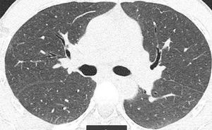 Tomografía computarizada de tórax: patrón nodular centroacinar.
