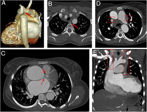 Posterior view 3D volume rendering CT angiography image (A) and axial CT scan in mediastinal window (B) show a coexistence of the aberrant right subclavian artery (long arrow) and aortic coarctation. The aberrant right subclavian artery originates from the aortic coarctation segment. Axial CT scan (C) reveals the circumflex artery (dashed arrow) and left descending coronary artery (short arrow) originating from aorta directly. Axial (D) and coronal (E) CT angiography scans show a double superior vena cava anomaly (frames). All CT scans also reveal cardiomegaly and ascending aortic aneurysm.