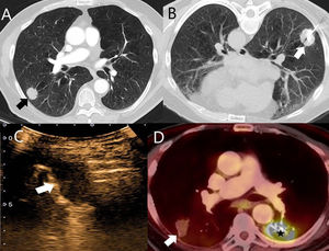 A) TC de tórax con contraste yodado intravenoso y ventana de pulmón. Se observa un nódulo subpleural sólido (flecha) en un paciente con enfermedad metastásica de un carcinoma escamoso cutáneo de células basales. Este nódulo se decidió tratar mediante ARF guiada por TC. B) Corte axial con el paciente en decúbito supino, durante la realización de la ARF guiada por TC. Se utilizó una aguja tipo «paraguas» (flecha). C) CEUS pulmonar de la misma lesión. No se observa captación de contraste durante todo el procedimiento, lo que indica una respuesta completa al tratamiento ablativo. D) PET-TC de tórax del mismo paciente un año después del tratamiento ablativo. Muestra disminución en el tamaño de la lesión tratada y ausencia de captación de FDG (flecha), concordante esto con una respuesta completa. Se observó un aumento patológico de la FDG en la lesión del lóbulo inferior izquierdo tratada con radioterapia (estrella).