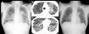 Chest X-ray showing a mass shadow in the left hilar region and bilateral diffuse interstitial opacities (A). Computed tomography revealing a mass in the left upper pulmonary lobe (B), pulmonary carcinomatosis lymphangitis, and minor bilateral pleural effusions (C). Chest X-ray showing marked improvement after four weeks of treatment (D).