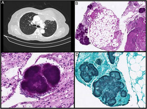 A)Gran masa en la pared torácica anterior izquierda que afecta a los músculos pectorales menor y mayor con consolidación parenquimatosa pulmonar subpleural subyacente. La lesión pulmonar presenta broncograma aéreo en su interior. B)Muestra histopatológica (40×) teñida con tinción de PAS en la que se evidencia un fragmento de tejido fibroadiposo con presencia de reacción inflamatoria mixta y gránulos actinomicóticos (colonias de Actinomyces). C)Imagen de un gránulo actinomicótico teñido con tinción de PAS, englobado por un infiltrado inflamatorio con abundantes leucocitos polimorfonucleares (400×). D)Muestra anatomopatológica procesada con tinción de plata metenamina que visualiza la presencia de filamentos de Actinomyces que se disponen en empalizada en la periferia del gránulo (400×).