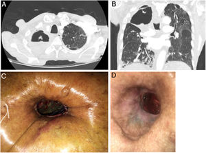 Cortes axial (A) y coronal (B) de la cavidad pulmonar que ocupa prácticamente todo el lóbulo superior derecho. Cavernostoma en primeros días postquirúrgicos (C). Cavernostoma tras varios meses con curas locales (D).