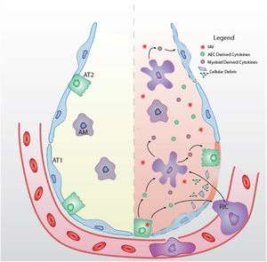 Schematic model of IAV-induced ARDS (Left) The healthy alveolus is free of fluid with tight junctions between alveolar type 1 (AT1) and type 2 (AT2) epithelial cells. Tissue resident alveolar macrophages (AM) facilitate lung homeostasis through clearance of cellular and environmental debris. (Right) Upon inhalation, IAV targets alveolar epithelial cells (AEC) for infection and replication. IAV infection induces epithelial cytokine production that recruits immune cells to the airspace. Recruited immune cells (RIC) contribute to hyper-inflammatory environment and which further contributes to cytokine storm and tissue damage (dashed outline). Barrier disruption due to the denuded epithelium allows extravasation of proteinaceous edema fluid into the airspace that disrupts gas exchange and causes ARDS.