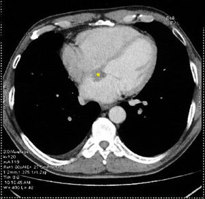 A thoracic computed tomography showing low-density mass located in the interatrial septum.