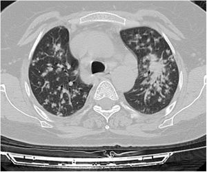 Axial thoracic CT scan with lung parenchyma window of a 58-year-old female patient showing micronodular densities with uniform dispersion in bilateral lung parenchyma. The patient has been followed for 4 years due to PAE.