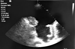 Imagen ecográfica de derrame pleural y engrosamiento pleural.