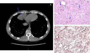 A) Imagen TC, flecha: masa bien definida en mediastino anterior. B) Microscopía óptica con hematoxilina-eosina. C) Microscopía óptica con anticuerpo S100.