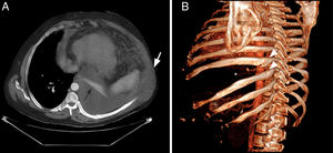 A) TC de tórax (vista axial) donde se muestra la herniación del derrame pleural izquierdo hacia la región subcutánea adyacente (flecha blanca). Obsérvese la atelectasia completa del lóbulo inferior izquierdo (flecha negra). B) Reconstrucción tridimensional de la TC (proyección oblicua posterior izquierda), que muestra fracturas de la región posteromedial (punta de flecha) de 2 costillas contiguas (octava y novena) y un ensanchamiento significativo del octavo espacio intercostal (asterisco).