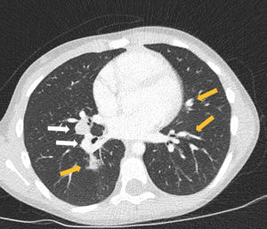 Chest computed tomography scan showing lymph nodes (white arrows) and parenchymal opacities (yellow arrows).