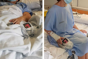 Se puede observar la diferencia de saturación en sedestación respecto al decúbito, así como el incremento de la frecuencia cardiaca.