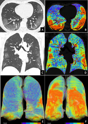 A y B) Imágenes de la tomografía computarizada, el plano axial (A) y el plano coronal (B). C y D) Posprocesamiento de las mismas imágenes en percentiles de valores de atenuación. E y F) Reconstrucciones volumétricas en las proyecciones anterior (E) y posterior (F). Las imágenes de la tomografía computarizada muestran un patrón predominante en vidrio deslustrado de distribución periférica y predominio posterior con líneas subpleurales (flechas) e ingurgitación vascular (punta de flecha), signos compatibles con COVID-19. Nótese que la codificación en color de los percentiles de valores de atenuación permite cuantificar la extensión de la inflamación y la carga inflamatoria. La extensión de la inflamación, afectando fundamentalmente a los segmentos posteriores, se pone de manifiesto de manera más visual en las reconstrucciones volumétricas (en color azul se muestra la densidad pulmonar normal, mientras que los colores anaranjados y rojos muestran la actividad inflamatoria).