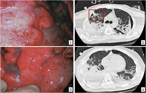 1) Imagen quirúrgica, placa blanquecina e indurada con retracciones pleurales en región anterior del lóbulo inferior derecho. 2) Imagen de la TC, retracciones pleurales (señalado) y parcheado bilateral con relación a neumonía COVID-19. 3) Imagen quirúrgica, retracciones pleurales difusas en parénquima sano. 4) Imagen de la TC; hemotórax derecho con drenaje torácico en su interior, lesiones bilaterales parenquimatosas correspondientes a neumonía por COVID-19.