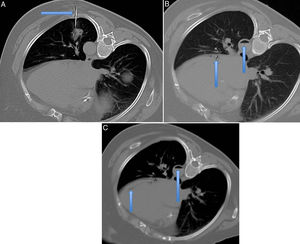 Cortes axiales de la TC para la realización de una biopsia pulmonar con la paciente colocada en decúbito lateral derecho. A) En la imagen superior izquierda se puede ver señalada la aguja tru-cut abordando la lesión alojada en el lóbulo inferior izquierdo (flecha). B) La imagen superior derecha muestra, señalado por flechas, la existencia de aire dentro de la arteria aorta descendente (flecha) y en la arteria circunfleja (flecha). C) En la imagen inferior se demuestra la existencia de aire en el interior del ventrículo izquierdo (flecha).