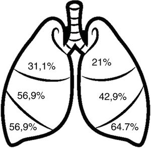 Distribución por lóbulos de las bronquiectasias.
