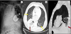 1A) Radiografía de tórax. Atelectasia subtotal del pulmón derecho, cánula de eyección de ECMO en yugular derecha y cánula de succión en vena cava inferior. Tomografía computarizada con contraste (fase arterial, ventana de pulmón). 1B) Se observan focos de infiltrado en vidrio deslustrado (flechas amarillas) pulmonares bilaterales de predominio central. Consolidación en lóbulo inferior derecho (flecha roja). 1C) Se demuestra la permeabilidad del árbol bronquial en el seno del foco consolidativo.