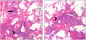 A: Chronic HP showing granulomas (arrows) and extensive peribronchiolar metaplasia (arrow-head); B: another area showing peribronchiolar metaplasia along with fibrosis.