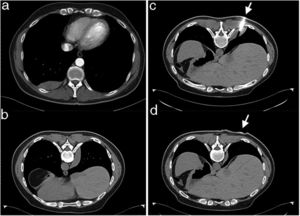 (a) CTPA revealing a right sided, well circumscribed, pleural based, soft tissue mass. (b) CT in prone position after CT guided FNB was completed, showing mass with lateral paravertebral displacement. (c) Patient in the prone position, the needle inserted during CT guided FNB (the arrow shows the insertion point). (d) The same level as (c), right after removal of the needle when CT guided FNB was completed (the arrow shows the point where the needle was previously inserted). Apart from lateral displacement shown in (b), craniocaudal displacement of the mass is evident too.