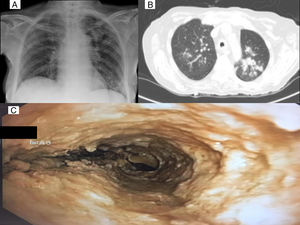 A) Rx de tórax: infiltrados parenquimatosos en lóbulo superior izquierdo y lóbulo inferior izquierdo. B) TC de tórax: infiltrados en ambos lóbulos superiores, de predominio en LSI. C) Endoscopia: traqueobronquitis aspergilar pseudomembranosa.