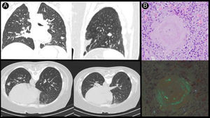 Amiloidosis.