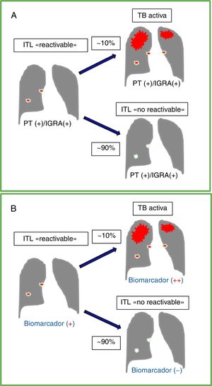 Curso natural de la infección tuberculosa latente (ITL), pruebas diagnósticas y biomarcador ideal. A. Muestra el curso de una ITL sin tratamiento en un individuo inmunocompetente con un riesgo de 5-10% de desarrollar en el tiempo una tuberculosis (TB) activa. Las pruebas disponibles para ITL, tanto la de la tuberculina (PT) como los ensayos de liberación de interferón-gamma (IGRA), dan usualmente resultados positivos antes y después de la reactivación de la TB activa. B. Muestra los resultados de una prueba con un biomarcador ideal que pueda diferenciar infección latente con potencial de reactivación (ITL «reactivable») vs. un individuo con resultados positivos en la PT y/o IGRA pero sin riesgo significativo de reactivación (ITL «no reactivable»). Un marcador ideal podría incrementarse significativamente al progresar de una ITL «reactivable» a una TB sintomática.
