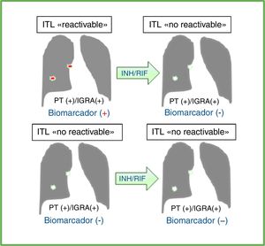 Efecto del tratamiento preventivo en las pruebas diagnósticas y biomarcador ideal en individuos con infección tuberculosa latente (ITL) reactivable vs. no reactivable. Efecto del tratamiento preventivo con isoniazida (INH) y/o una rifamicina (RIF) en los resultados de la prueba de la tuberculina (PT) y/o los ensayos de liberación de interferón-gamma (IGRA) en individuos con diagnóstico de ITL. Las pruebas diagnósticas disponibles no diferencian los individuos con ITL con potencial de reactivación (ITL «reactivable») de aquellos que ya erradicaron bacteriológicamente o contuvieron la infección tuberculosa de manera efectiva y permanente (ITL «no reactivable»). Un biomarcador ideal debería ser detectado antes del tratamiento preventivo para la ITL y no después en los casos de la ITL reactivable. En los casos de ITL no reactivable, el marcador ideal no debería ser detectado antes ni después del tratamiento. Esto no ocurre con los resultados de la PT y/o IGRA, que usualmente se mantienen positivos después del tratamiento preventivo. Por consiguiente, un biomarcador ideal mejoraría la selección de individuos que realmente se beneficiarían del tratamiento para la ITL y, de este modo, serviría para evitar dar tratamiento preventivo a las personas que no lo necesiten o que tengan un riesgo significativo de desarrollar efectos secundarios a estos antibióticos.