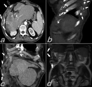 (a–d) Abdominal CT scan, axial slice (a), sagittal (b), coronal (c), and coronal T2-weighted magnetic resonance imaging (d) show local metastasis to the skin, subcutaneous tissue (solid arrows), pleura, ribs (empty arrows) and sternum xiphoid process (white star).