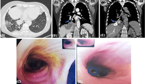 (A) Axial thoracoabdominal-CT image shows ground glass opacities on right lower lobe. (B) Coronal thoracoabdominal-CT image shows new right subphrenic collection contiguous with diaphragm, consistent with an abscess; multiples focal hepatic lesions, one extending to right lung base, with a fistulous track (arrow). (C) Bronchofibroscopy revealed yellowish secretions in all bronchial tree. (D) Bronchofibroscopy revealed mucosa inflammation of medial basal segment of right lower lobe bronchus, from where yellowish secretions flowed, confirming fistulization site (circle). (E) Coronal CT image performed after embolization of the fistulous track shows the presence of high-attenuation embolization material (metallic coils and cyanoacrylate glue) in the right subphrenic space extending into the thorax (arrow).