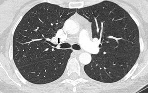 CT scan image with hyperdense lesion on main right bronchi.