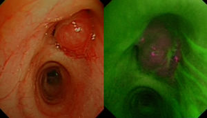 (A) Endobronchial view of pendunculated lesion on right upper lobe bronchus with white light. (B) Negative autofluorescence bronchoscopy of endobronchial lesion.