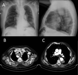 A) Radiografía PA y lateral de tórax donde se observa ensanchamiento mediastínico con imágenes que impresionan de masas. B) TC de tórax con contraste intravenoso, que muestra una arteria subclavia derecha aberrante que se origina en el cayado aórtico distalmente a la subclavia izquierda discurriendo por detrás del esófago hacia el lado derecho, con voluminoso aneurisma parcialmente trombosado. C) Aneurisma de la aorta descendente parcialmente trombosado.