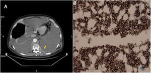 (A) Axial computed tomography (CT) image shows bilateral pleural effusion and parietal pleural thickening exhibiting the sandwich sign on the left side (arrow). (B) Immunohistochemistry showing lymphoid cell highlighted by BCL2 marker.