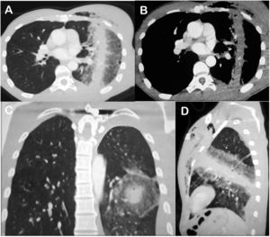 Axial CT images of the chest obtained with the lung (A) and mediastinal (B) window settings, demonstrating tubular consolidation (hematoma) crossing the left lung with peripheral ground-glass opacities (contusion). Note also a small pleural effusion and subcutaneous emphysema in the anterior chest wall. (C) Coronal reconstruction showing the aspect of a nodule with a halo of ground-glass opacity (halo sign). (D) Sagittal reconstruction showing the tubular opacity along the posteroanterior bullet trajectory.
