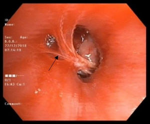 Bronchoscopic view demonstrating growth in middle lobe with white hair strands seen overlying the growth.