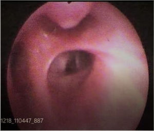 Bronchoscopic view demonstrating nipple-like projection at the opening of right upper lobe apical segment.