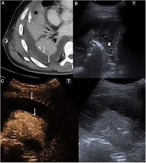 A-C. Empiema pleural bacteriano. A: Imagen axial de TC en la que se evidencia derrame pleural con engrosamiento e hipercaptación de las hojas pleurales (flechas blancas) coherente con el signo de la pleura hendida. B: Ecografía torácica donde se observan múltiples ecos y septos en el líquido pleural, sin loculaciones evidentes (asterisco), hallazgos no apreciables en la TC previa. C: Ecografía torácica con contraste. La imagen de la izquierda corresponde a la exploración con contraste ecográfico, 70segundos después de su administración, y la de la derecha a la prueba convencional. En la imagen con contraste se identifica el engrosamiento e hipercaptación de las hojas pleurales parietal y visceral (flechas blancas), hallazgos superponibles a los descritos en la figura A.